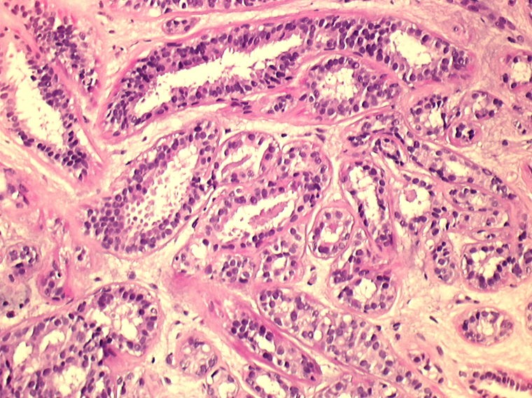 Carcinoma mammario - tumore al seno