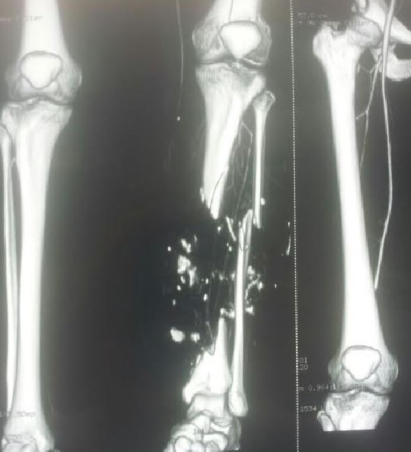 tibia ricostruita